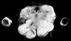 Dorsolateral medullary infarct, with occluded right posterior inferior cerebellar artery